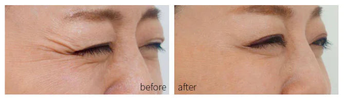 Photon Acne Treatment Facial Mask™